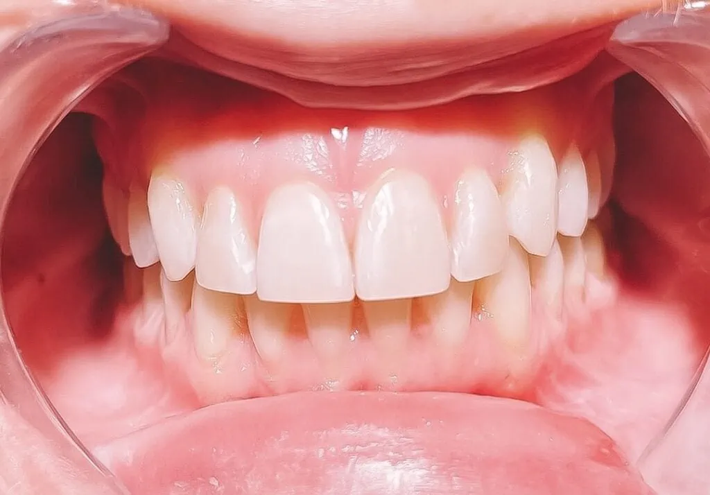 Kosten für Gerade Zähne nach Regulierung mit unsichtbarer Zahnspange