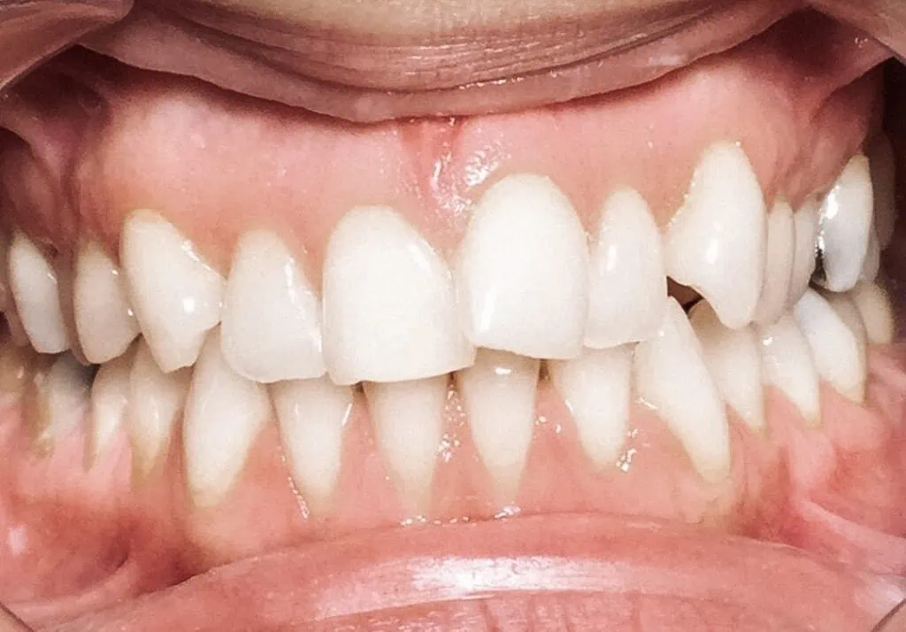 Bild mit schiefen Zähnen